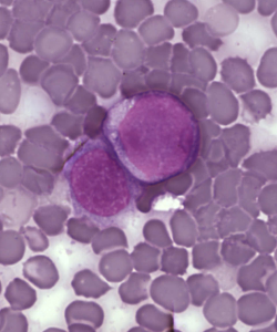 Células de leucemia (crédito: PLoS/Wikimedia Commons)