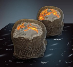 El efecto un día después de la activación cerebral: la imagen del cerebro presenta patrones espontáneos (estado de descanso) antes de una sesión de entrenamiento de neuroretroalimentación basado en fMRI. La parte frontal de la imagen presenta patrones espontáneos (estados de descanso) un día después d e la sesión, ilustrando el trazo de largo alcance en el entrenamiento. (Crédito: Weizmann Institute of Science)